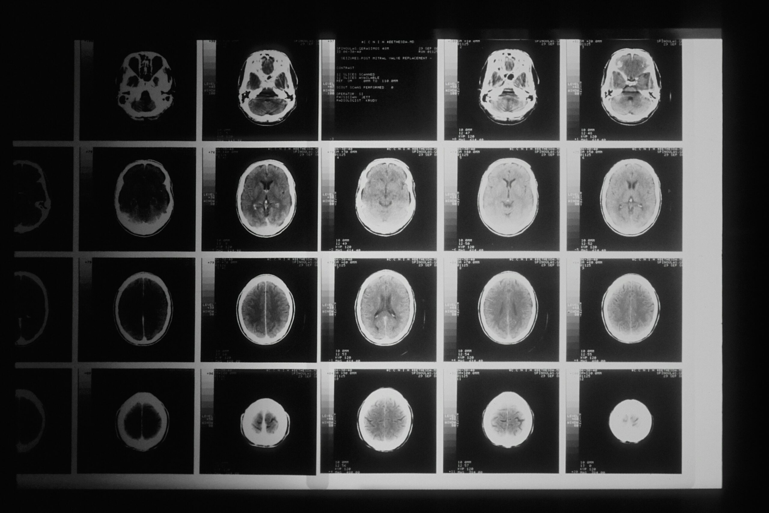a CT/X-ray scan shows different Types of Brain Injuries